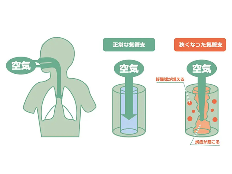 気管支喘息の病態図